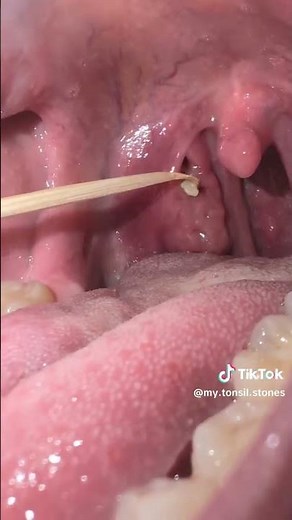 Large Tonsil Stone Removal