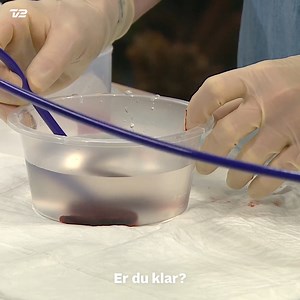Imponerende! 🩸 Afdelingslæge Asger Andersen fra Aarhus Universitetshospital har specialiseret sig i en ny metode, hvorpå blodpropper kan fjernes gennem et sugerør. Lige nu er han den eneste danske læge, der mestrer metoden. | Go' morgen Danmark og Go' aften Live