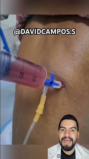 PLEURAL EFFUSION DRAINAGE