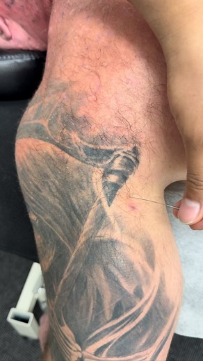 Posterior Cuff Needling Feeling like your body needs a reset? Click the link in the bio 🤝🏼 #physiotherapy #rehabnrun #physicaltherapy #sydney #viral #gym #fyp #painmanagement #shoulder | Rehab n Run