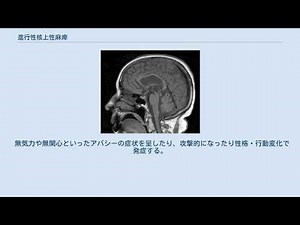進行性核上性麻痺