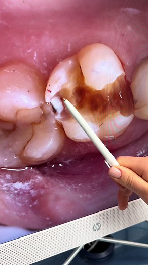 Dental Procedure: Tooth Removal Using HP Monitor
