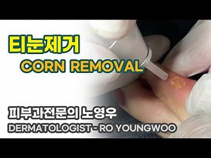 티눈제거(corn removal) #corn