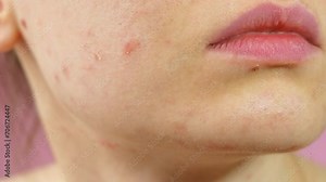 Close up skin with acne, peeling and enlarged pores. Dry skin with inflammation. Woman touching acne on her face. Skin problems, allergic, redness. Healing pimples. 4K Video