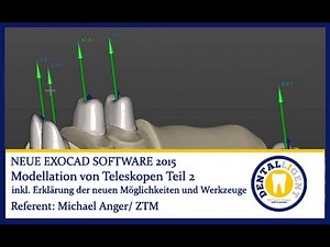 EXOCAD SOFTWARE 2015 - Modellation von Teleskopen TEIL 2