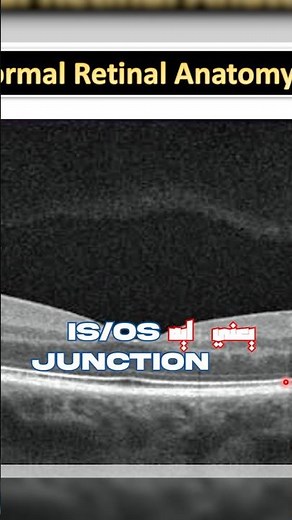 Lost IS/OS? What It Means for Vision 👇