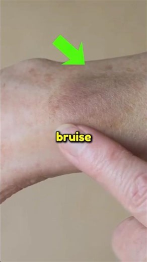 How Does A Bruise Form? Why Do You Bruise After a Shot? 💉😬 #shorts