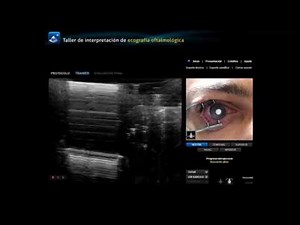 Taller de interpretación de ecografía oftalmológica