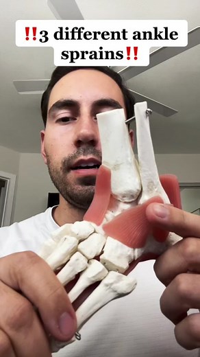 3 different ankle sprains! The lateral ankle sprain, medial ankle sprain, and high ankle sprain! They all have different prognosis and recovery timelines #anklesprain #sprainedankle #hoopers #anklerehab #physicaltherapy