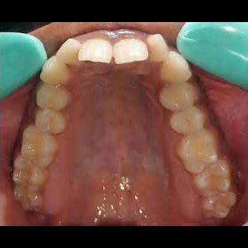 Class II Division II Malocclusion Correction achieved. www.alignersbraces.com 9900008081