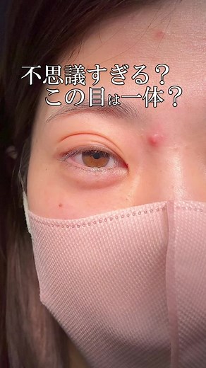 #二重整形 #二重埋没 #他院修正