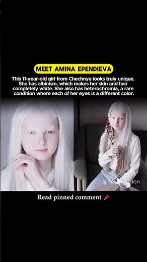 Girl With Heterochromia and Albinism Goes Viral! #RareBeauty #AlbinismAwareness #Heterochromia