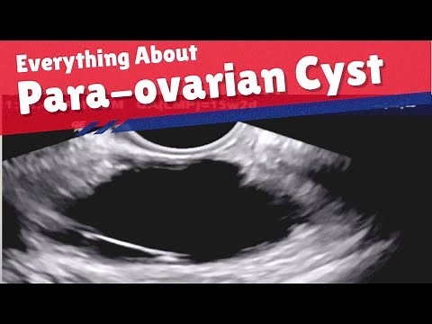 Para Ovarian Cyst - Ultrasound | How to Diagnose | Complications