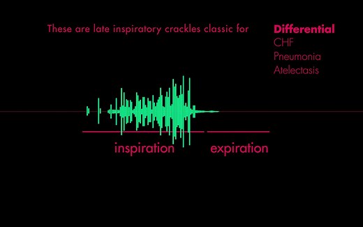 呼吸音听诊：细湿啰音（Coarse Crackle Lung Sounds）