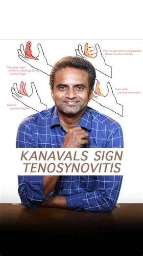 Dr. Sree Charan R J on Instagram: "KANAVEL SIGN- TENOSYNOVITIS The Kanavel sign is a crucial indicator in diagnosing tenosynovitis, characterized by tenderness along the flexor tendon sheath, finger held in slight flexion, and pain during passive extension. Early recognition aids treatment! FOR APPOINTMENTS Whatsapp: 99403 21202 Dr Heart healthcare Clinic AG-16, River view colony, 3rd street Anna Nagar East, Chennai 600040. Ph.8925380464,9994924992 #kanavelsigns #tenosynovitis #handhealth #ortho