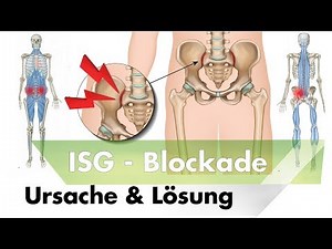 ISG Blockade | Symptome, Ursachen & Lösung durch Training