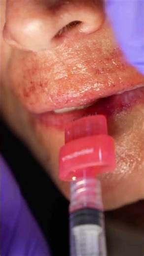 FULLER, SOFTER LIPS — WITHOUT THE “DONE” LOOK