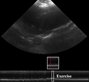 2.2K views · 33 reactions | A Nature paper presents a wearable ultrasonic device for continuous, real-time and direct cardiac function assessment. Read the paper: https://go.nature.com/3wxUBpN | Nature Portfolio | Facebook