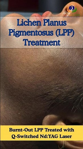 Lichen Planus Pigmentosus Treatment | Dermatologist Approved