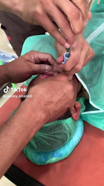 Intubation with ETT #generalanesthesia #anesthesia #hospitallife #doctor #anesthesiologist #opertiontheatersound #eyesurgery #operation #lifesaver #fyp #viral #foryoupage❤️❤️ #foruyou #generalanesthesiaproced #illu #hospitallife🤗🤗 #forupage