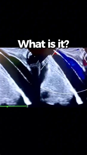 18K views · 70 reactions | Can Echocardiography Really Spot an Aortic...
