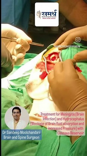 Treatment for Meningitis and Hydrocephalus with Ommaya Reservoir (CSF Diversion)