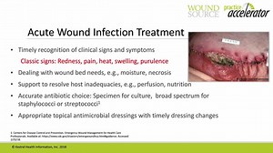 Miss "Clinical Challenges Associated with the Management of Wound Infections?" Watch the full webinar at: https://event.on24.com/wcc/r/1618798/64C6DDD13E6D2C3388DC9B760EF114CB?partnerref=WS_website?partnerref=socialmedia #WoundSourceWebinars | WoundSource | Facebook