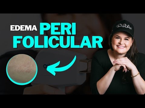 O QUE É EDEMA PERIFOLICULAR?