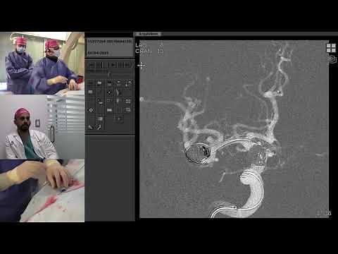 Transradial Coil Embolization of Unruptured Intracranial MCA Bifurcation Aneurysm