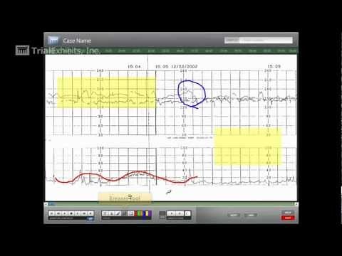Interactive Fetal Heart Strip