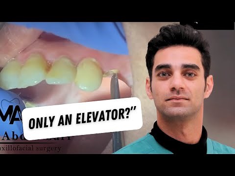 How to Extract a Broken Upper Root with ZERO Forceps! (Full Step-by-Step!)