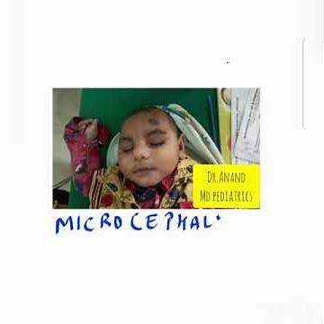 how do define MICROCEPHALY ?