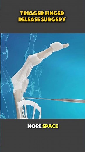 Trigger Finger Release Surgery | Step-by-Step Medical Explanation #TriggerFinger