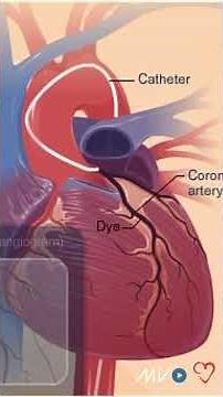 CORONARY ANGIOGRAPHY STEP BY STEP OVERVIEW