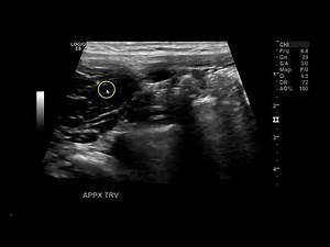 Appendix between RT External and Internal Iliac artery
