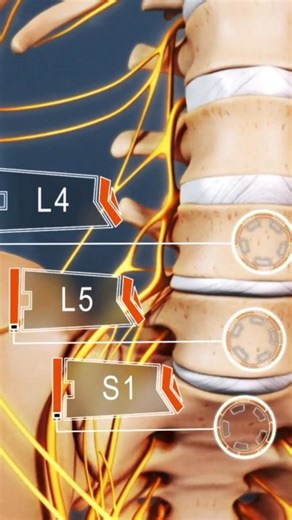 The vast majority of sciatica symptoms result from lower back disorders between the L4 and S1 levels that put pressure on or cause irritation to a lumbar nerve root. | Spine-health