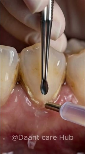 Calculus Buildup Vanishes – Plaque and tartar buildup near gums #dentist #dentalawareness