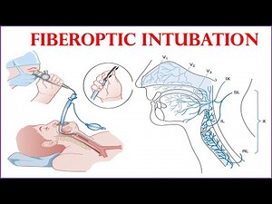 Awake fiberoptic intubation (full video)