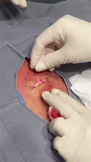 The Back Pop That Keeps Going