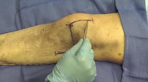 Open Approach to Supracondylar Humerus Fractures