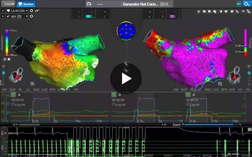 This patient attended the Affera case after a previous ablation performed abroad, for which no report is available. During the first PF Ablation with the powerful Sphere 9 catheter we successfully… | Izchak Lalmiav