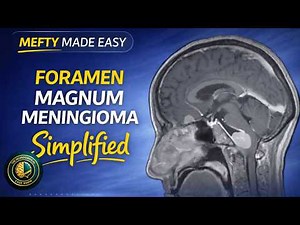 Foramen Magnum Meningioma | Foramen Magnum Surgical Anatomy | Part 1