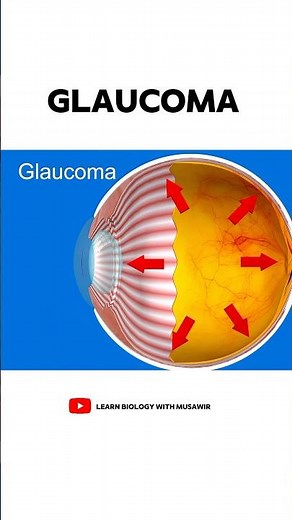 What is Glaucoma 👁️?