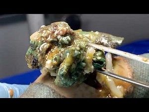 Zits pops removal pimple popper blackhead extraction whiteheads X2301 9624