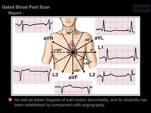 Gated Blood Pool Scan