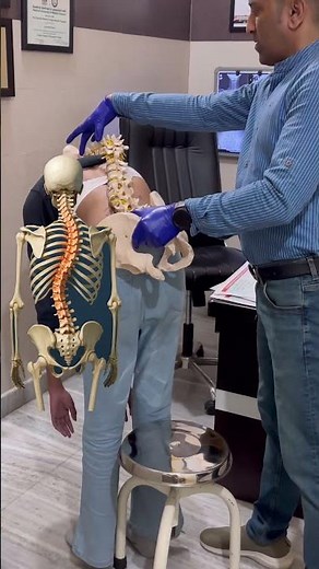 Best congenital scoliosis treatment by DrRavi #scoliosis #spine #chiropratic #reels #india #kyphosis