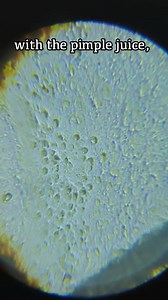 5.1K views · 176 reactions | What can we find in PIMPLE JUICE under the microscope?  (P.S. we found something really freaky!  #pimples #pimplepopper #pimple #microscope #microorganisms #bacteria #cells #biology #cellbiology #science #face #skincare #education | Just Keep Thinking | Facebook