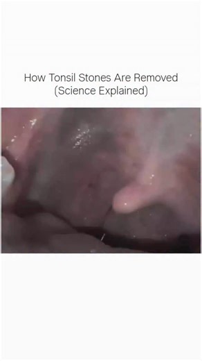 Science on Instagram: "Tonsil stones form when food particles, bacteria, and dead cells get trapped in the tonsils. Over time, these materials harden into small stones that can cause bad breath and discomfort. This video shows how tonsil stones are safely removed and explains the science behind the process. . . #biologyfacts #anatomy #medicalreels #satisfying #trending"