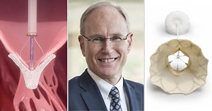 Surgeon Q&A: What’s The Latest Update For Non-Invasive TMVR?