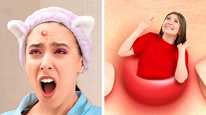 If a pimple were a person!😰 Awkward moments and weird hacks by 5-minute crafts like: | 5-Minute Crafts Like